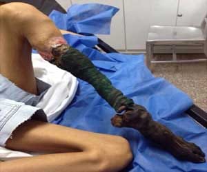 legs shrivels and turns black after snake bite