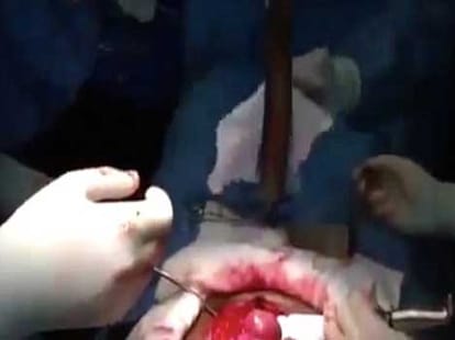 live giantfish removed from man's bowel