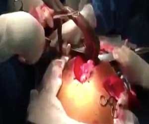 live giantfish removed from man's bowel