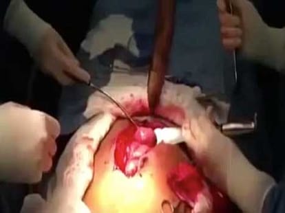 live giantfish removed from man's bowel