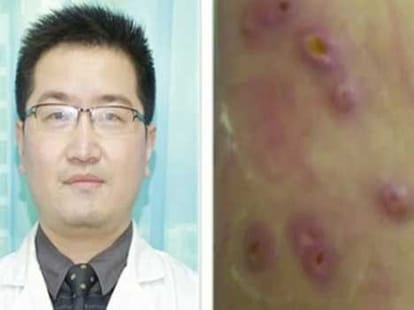 man has 20 live maggots living inside his body