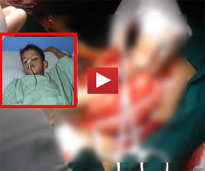 hair bundle found in a kid's stomach