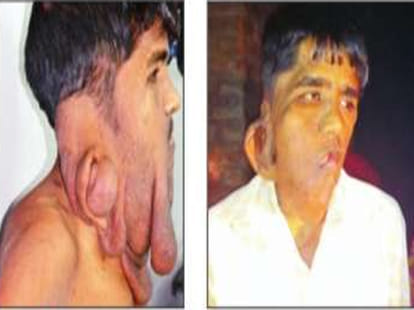 Elephant man's 22 year tumour operated.