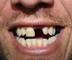 rapist arrested by his missing tooth