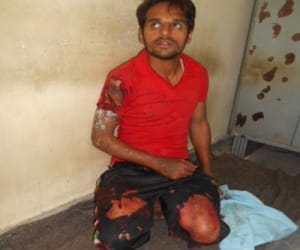 acid attack on woman in uttarakhand.