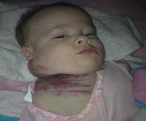 tumour that sprouted from blood vessel in neck