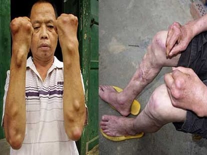 people suffering from unusual swellings