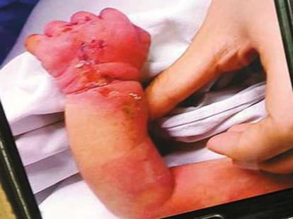 cannabil mom eats her newborn 