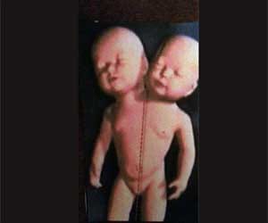 rare conjoined twins took birth