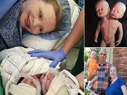 rare conjoined twins took birth