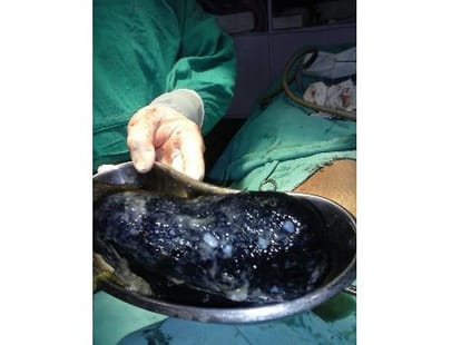 Doctors found hair in woman stomach.