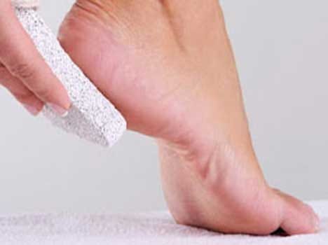 home remedies for cracked heels