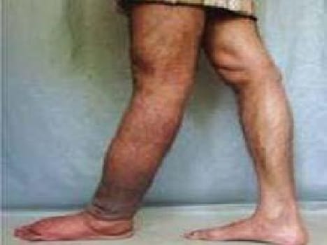 Filariasis Elimination Campaign stopped in up