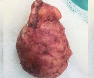 doctor removed brain tumour at chamba.