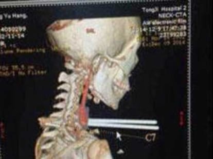 chopsticks stuck in throat