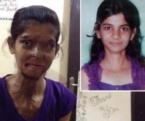 Meet to Acid Attack Victim Haryana National Player Ritu