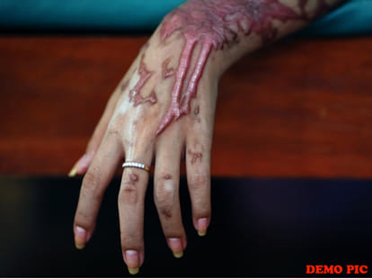 in acid attack her father registered a case against accused