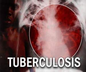 cement factories leads to Tuberculosis.
