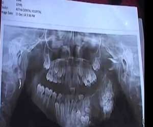 80 teeth found inside teenager's mouth