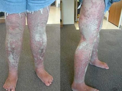 women with silveruy scaly skin