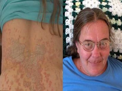 women with silveruy scaly skin