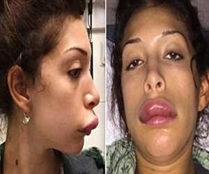 botched lip surgery left woman look like a duck