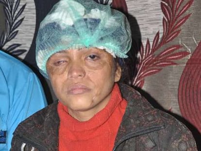 acid attack victim get free hair transplant.