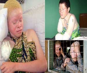 albino affected people are chopped and sold in markets for a better luck