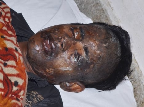 yuvak ke chehrye per tezab dala