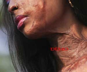 wife forced to drink acid after giving birth to daughters.