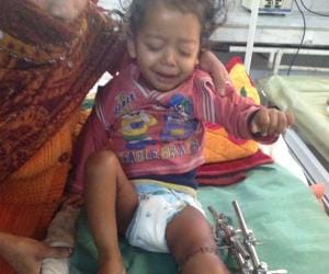 Doctors joined broken leg by special surgery.