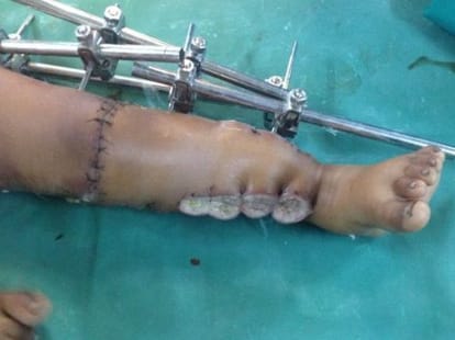 Doctors joined broken leg by special surgery.