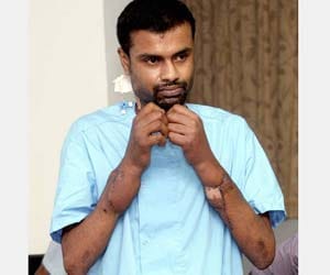 first time hand transplant in india