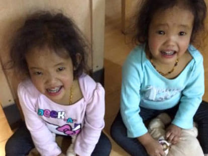 3-Year Old Twins Need A Liver Transplant 