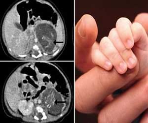 preganant baby girl born with two foetus 