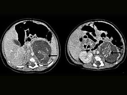 preganant baby girl born with two foetus 