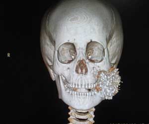 xray of boy whose face was accidentaly blasted by a shotgun