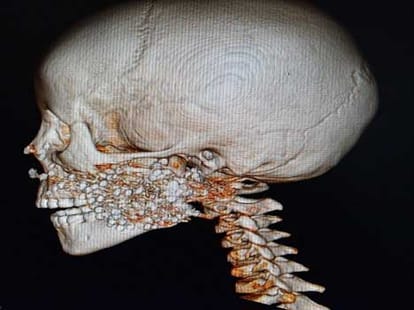 xray of boy whose face was accidentaly blasted by a shotgun