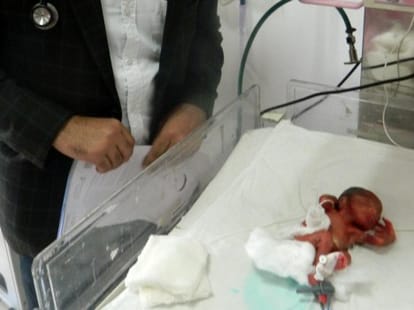 woman gave birth 600 gm child.