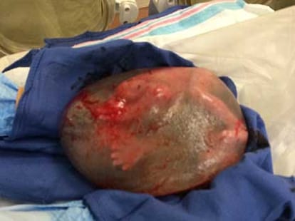 baby comes out with amniotic cell intact