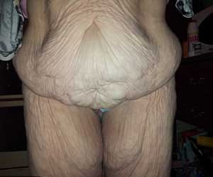 women left with saggy skin post weight loss surgery