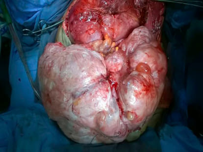 woman has four year old tumour in abdomen