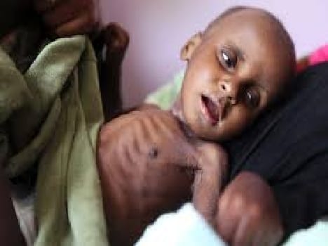 Malnutrition : difference in standards childs in problem 