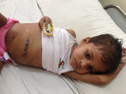 massive hairball removed from toddlers stomach