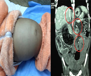 massive hairball removed from toddlers stomach