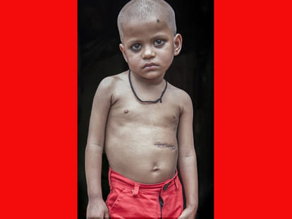 massive hairball removed from toddlers stomach