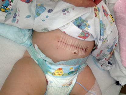 baby suffering from ovarian cancer