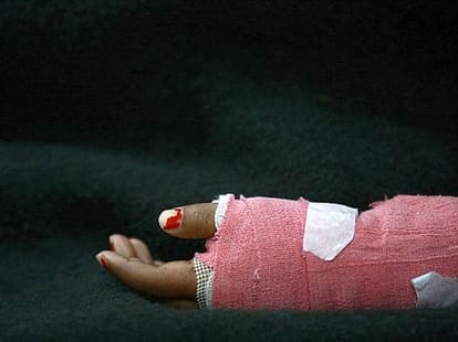 Acid attack: Russian woman in critical condition, eyesight finish