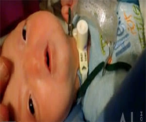 baby without a nose