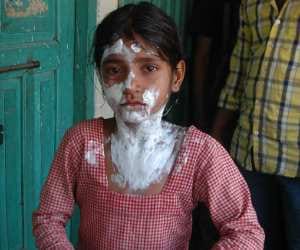 girl student burn from hot porridge during mid day meal